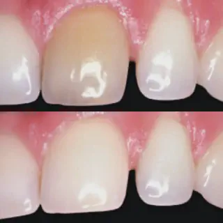 /img/25177-preventing-dead-teeth.webp