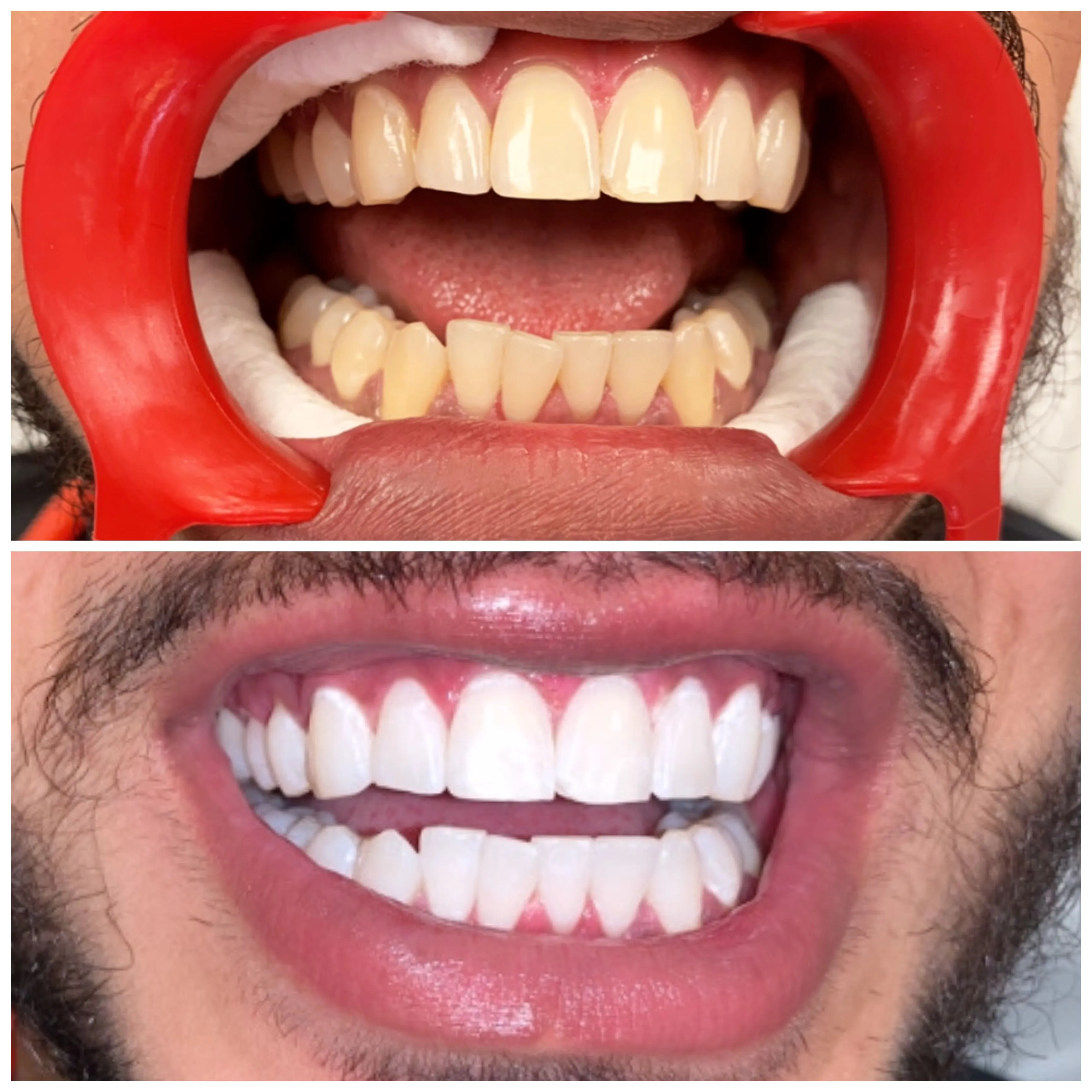 25177 professional teeth whitening