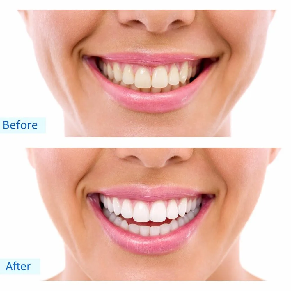 25178 at home teeth whitening