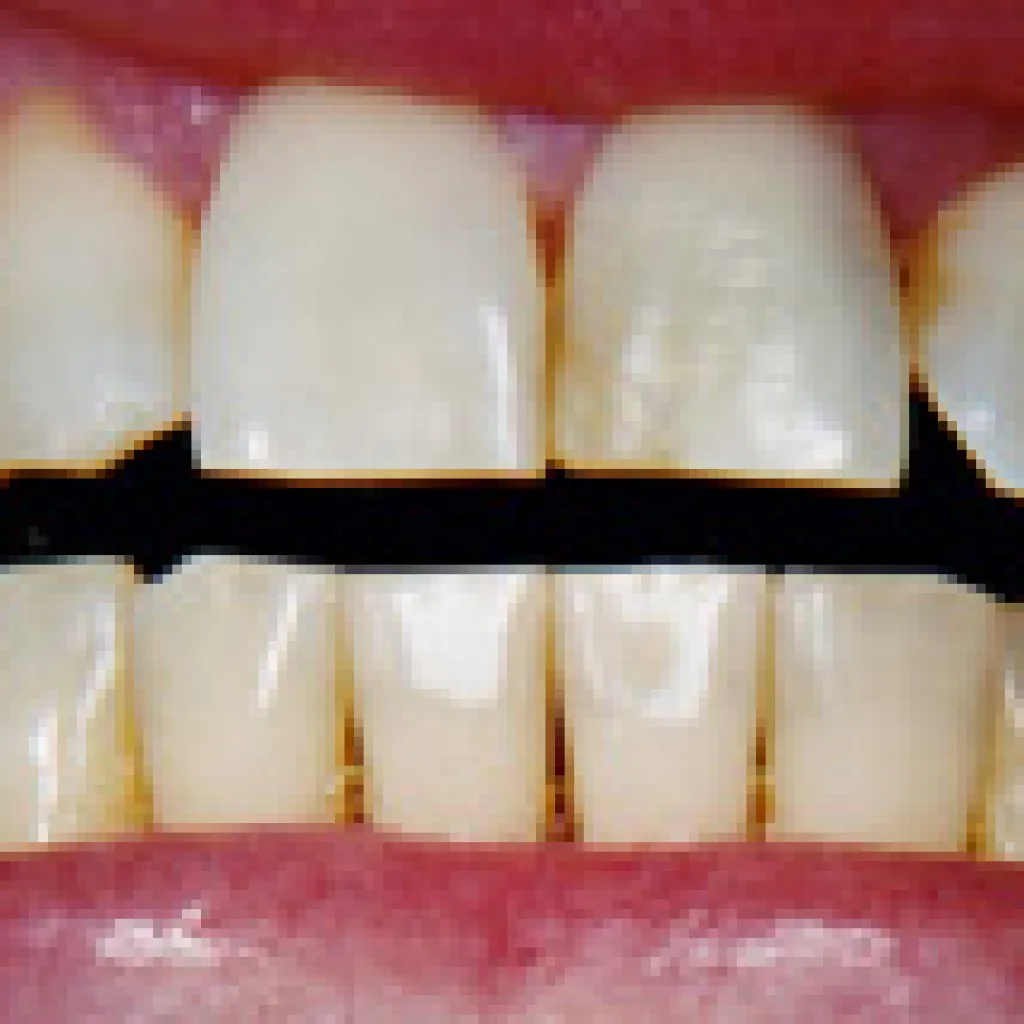 25183 tooth sensitivity