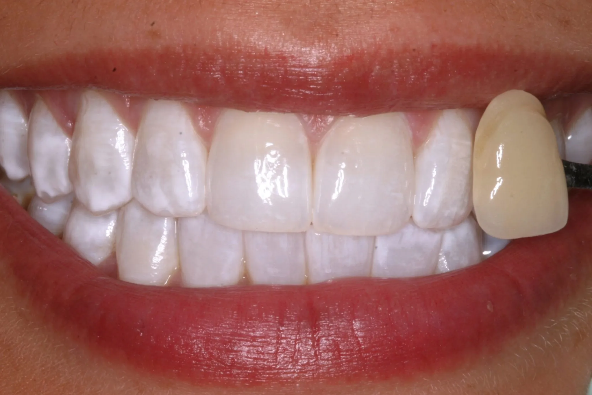 25189 dentist polaris teeth whitening
