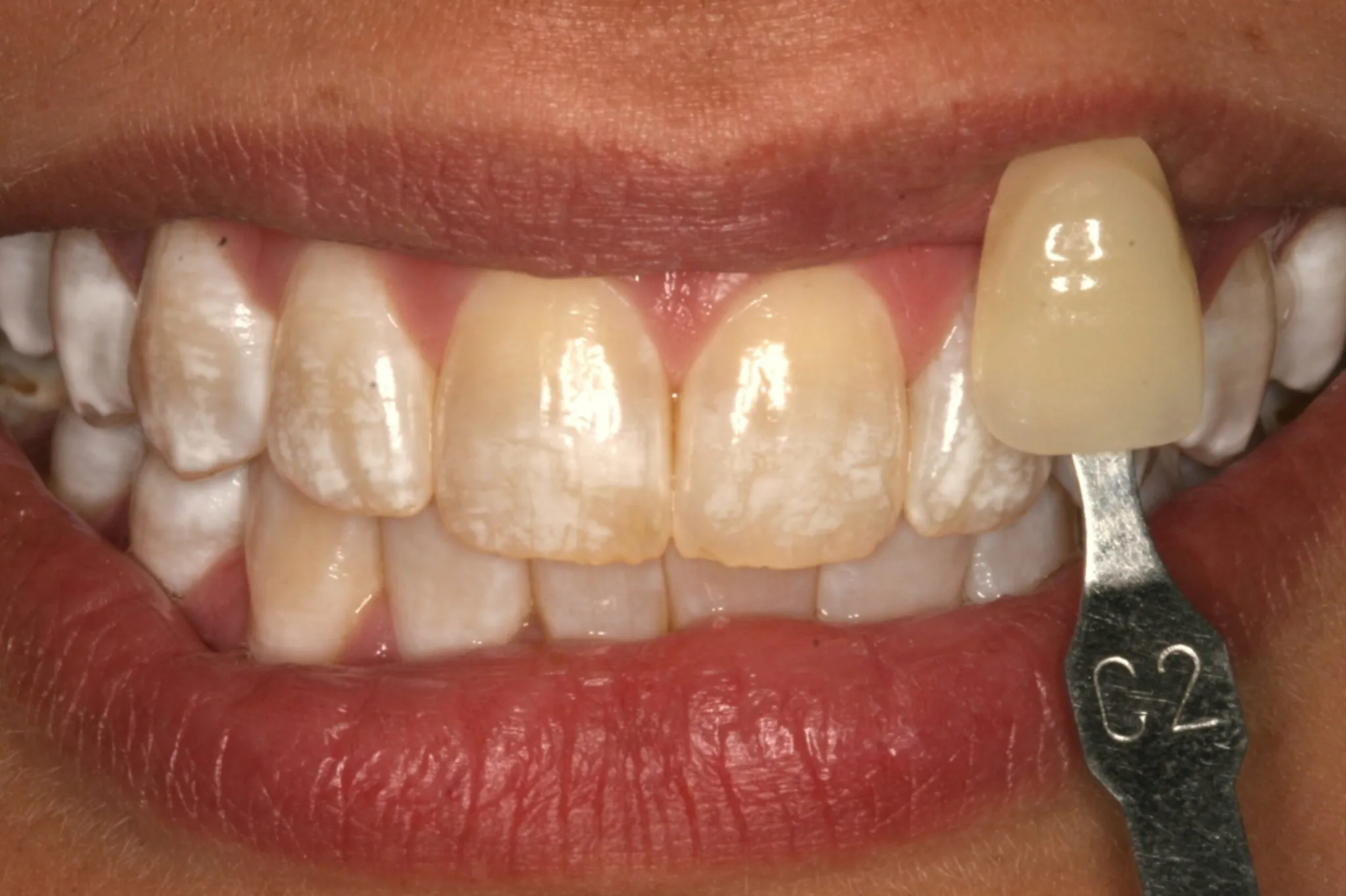 25189 polaris teeth whitening before after