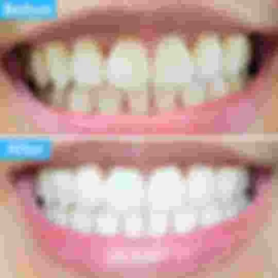 /img/25189-polaris-teeth-whitening-sensitivity.webp