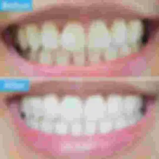 /img/25189-polaris-teeth-whitening-sensitivity.webp