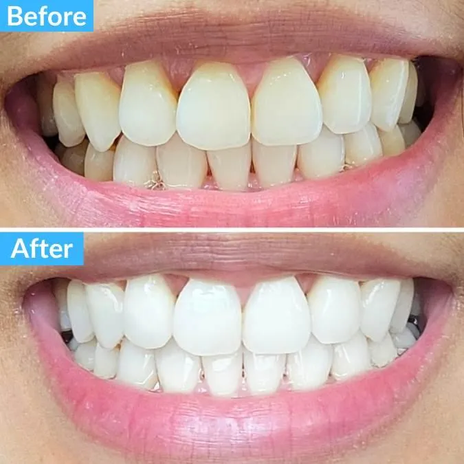 25189 smiling woman after teeth whitening