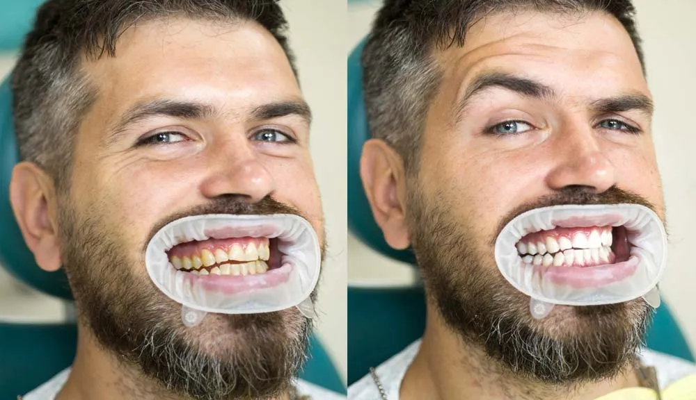 25191 laser teeth whitening