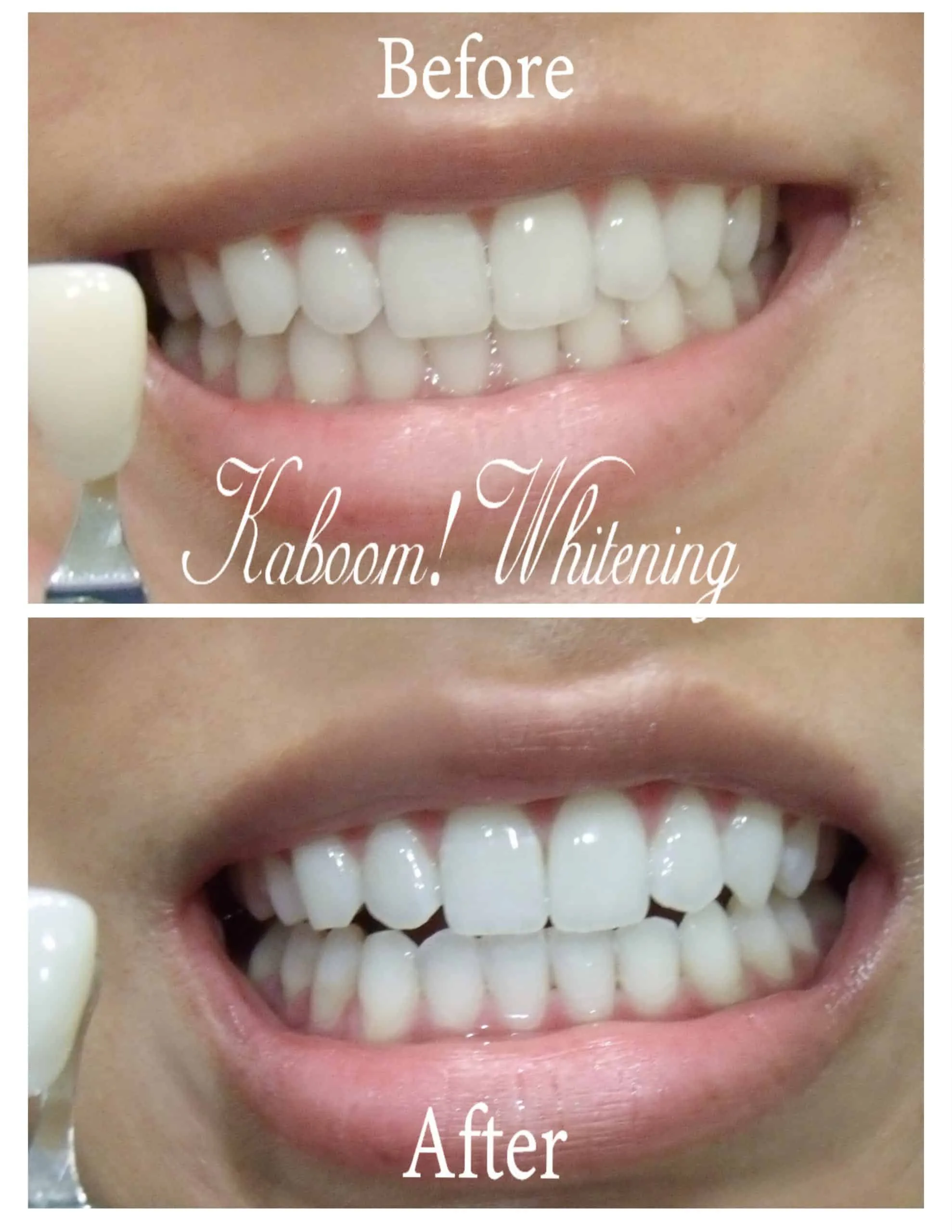 25191 teeth whitening diet
