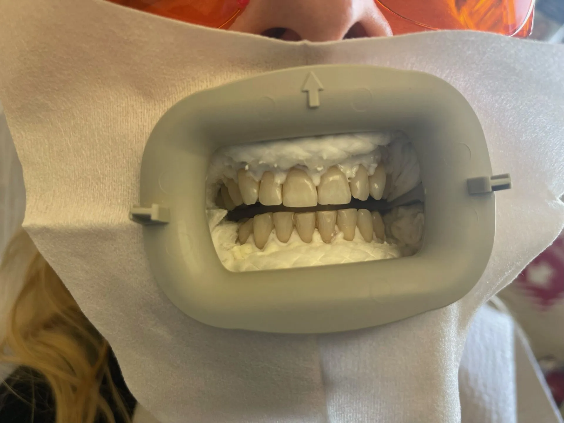 /img/25191-teeth-whitening-results.webp