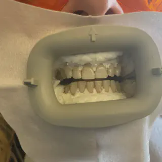 /img/25191-teeth-whitening-results.webp