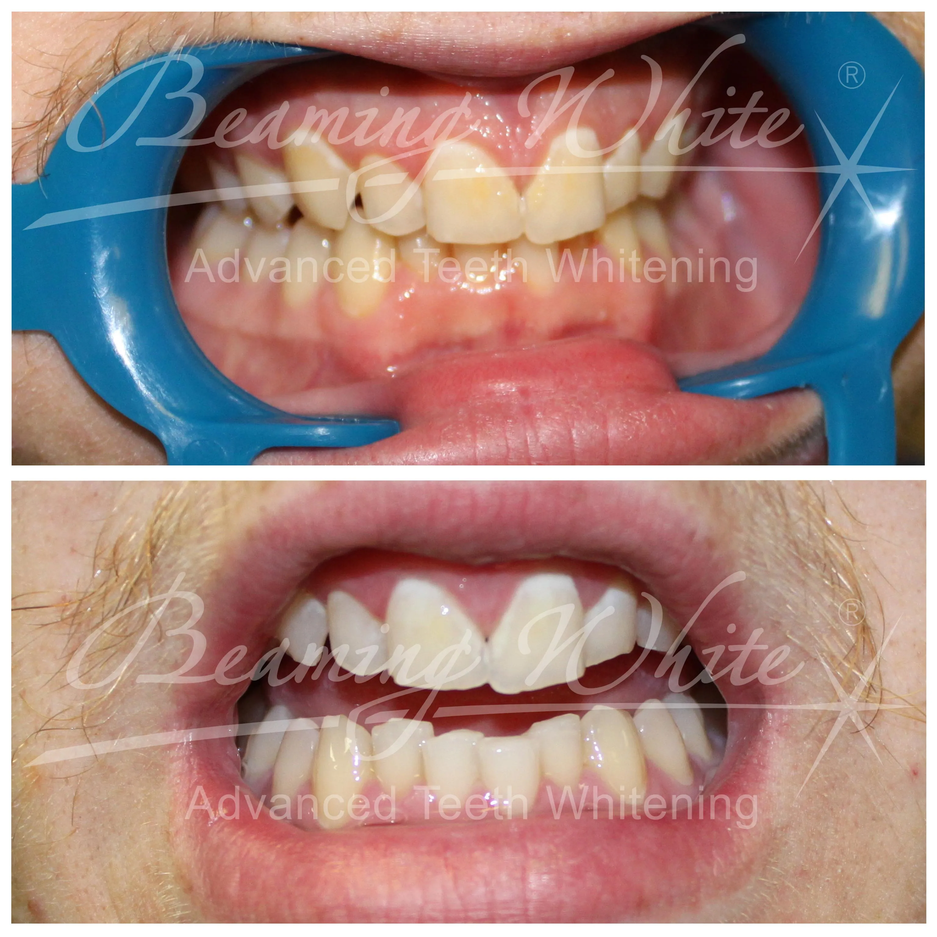 25195 teeth whitening diet