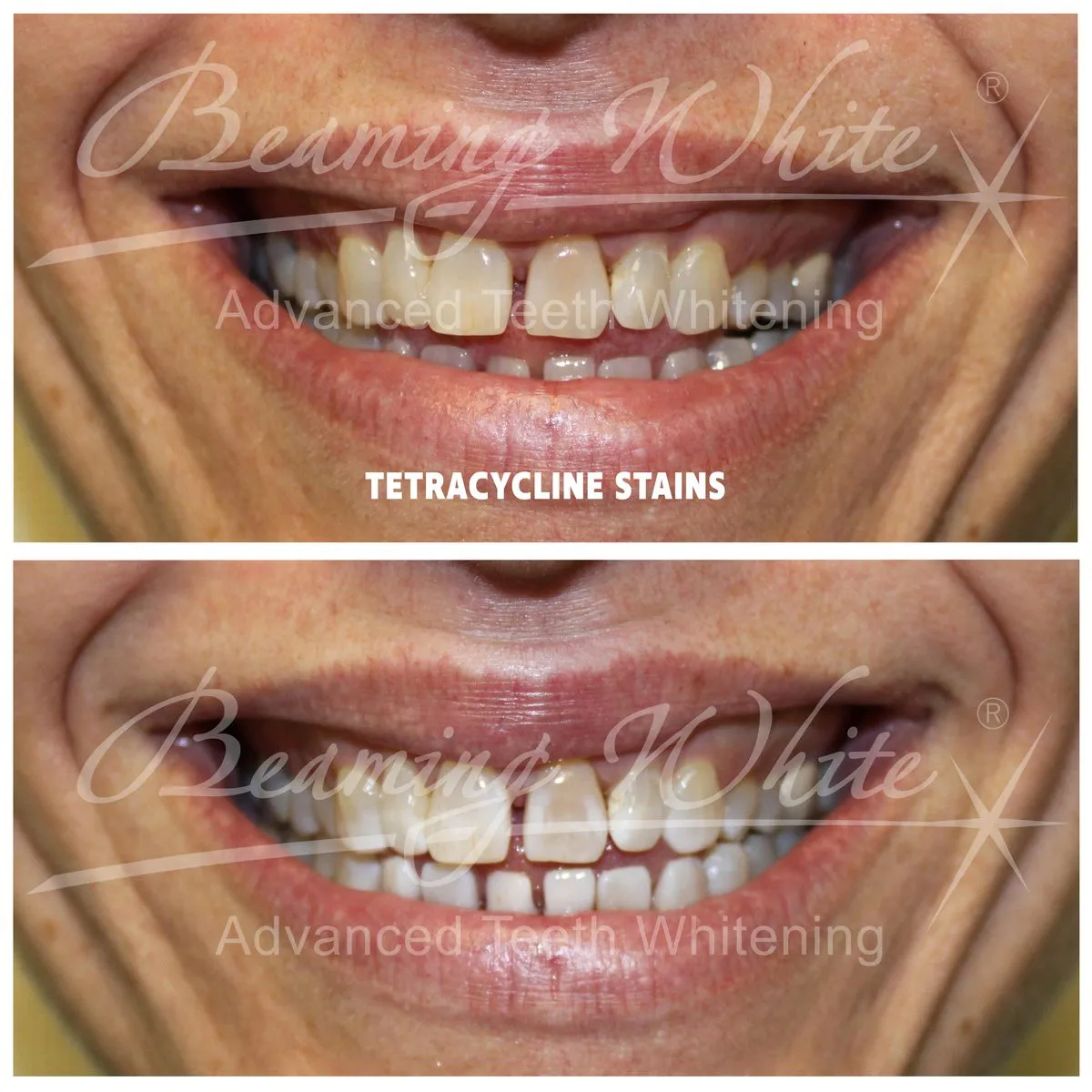 25195 teeth whitening maintenance