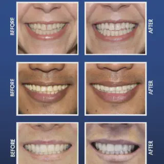 /img/25200-maintaining-white-smile.webp