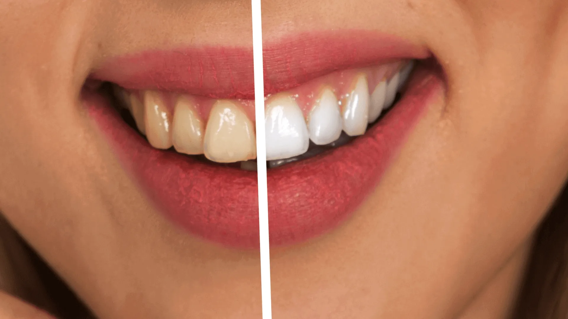 25202 zoom teeth whitening portland or 7