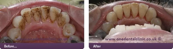 25205 airflow whitening smile aesthetics