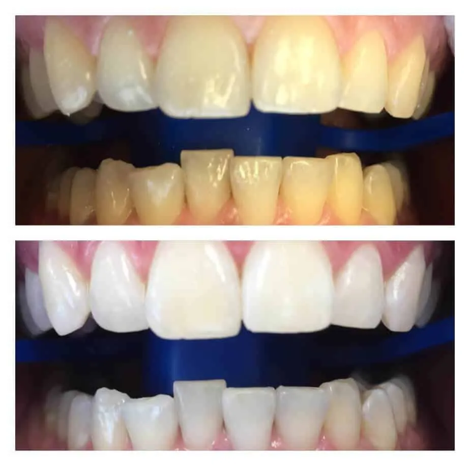 25210 in office teeth whitening