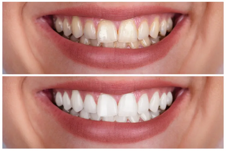 25210 teeth whitening cape town clinic