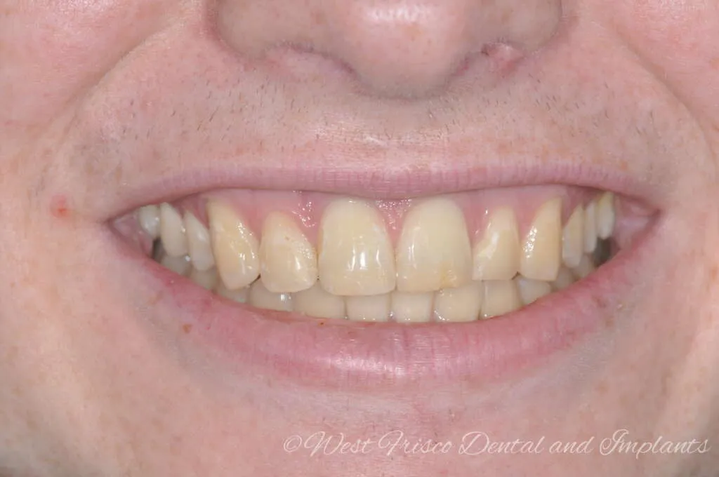/img/25212-zoom-teeth-whitening-nyc-cost.webp