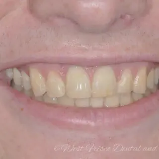 /img/25212-zoom-teeth-whitening-nyc-cost.webp
