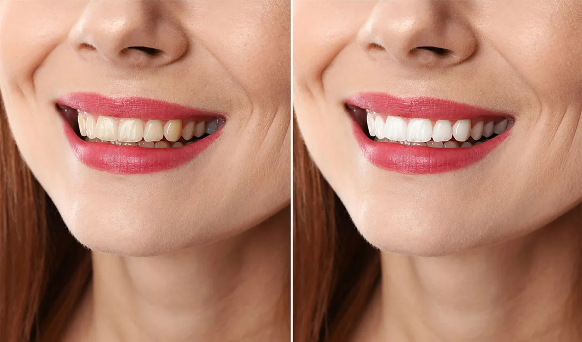 25212 zoom teeth whitening nyc smile confidence