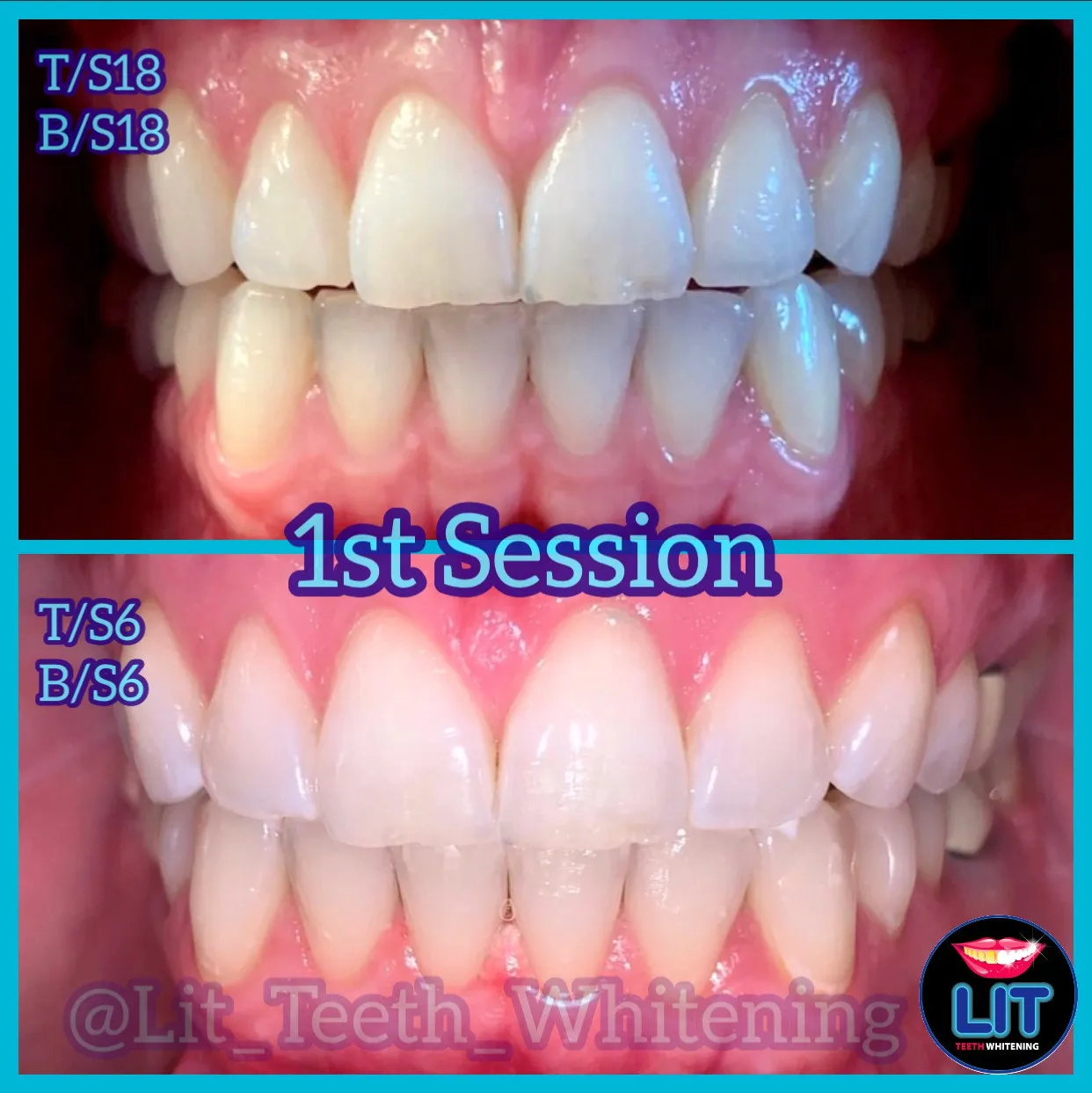 25215 teeth whitening kits
