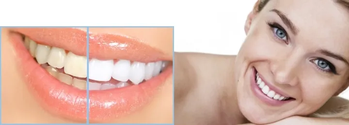 25218 teeth whitening maintenance