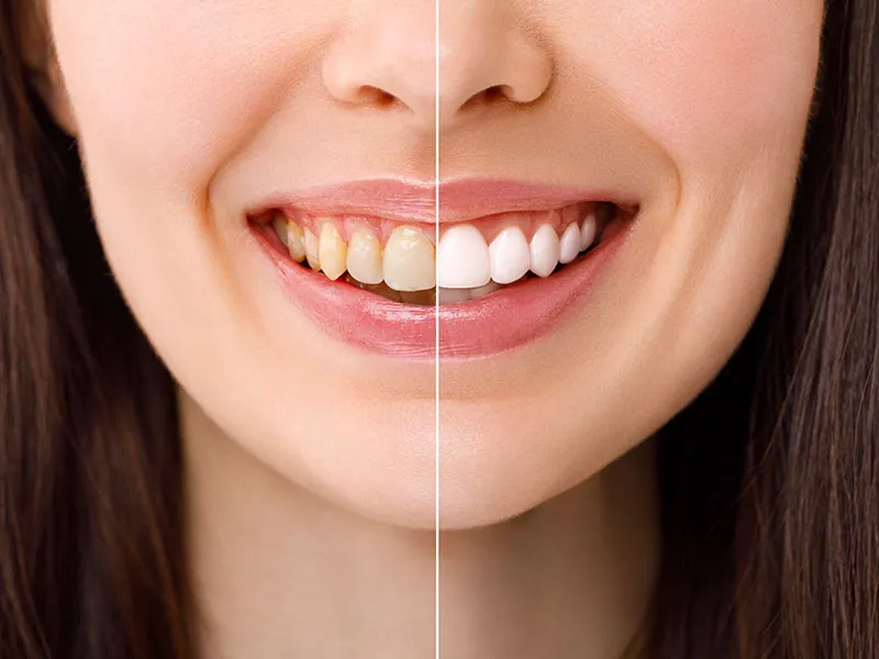 25221 professional teeth whitening