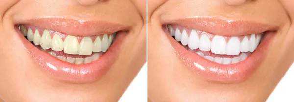 25221 teeth sensitivity