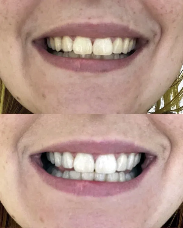 25232 post whitening care