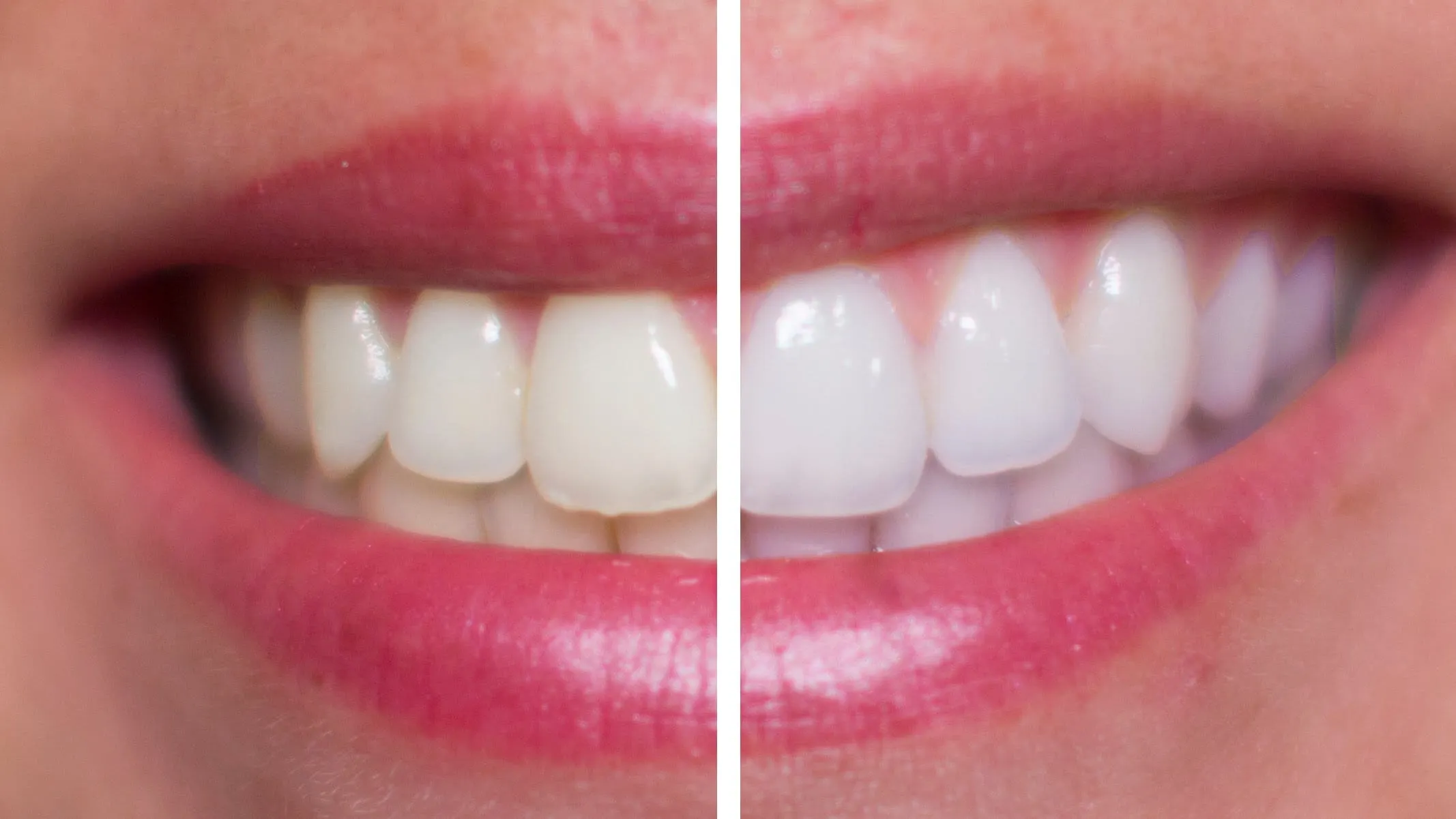 /img/25235-peroxide-teeth-whitening-7.webp