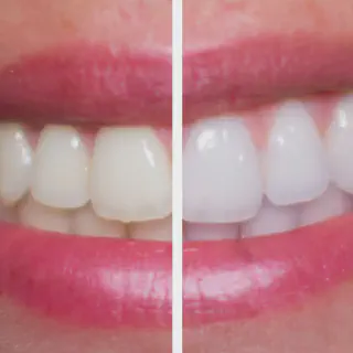 /img/25235-peroxide-teeth-whitening-7.webp