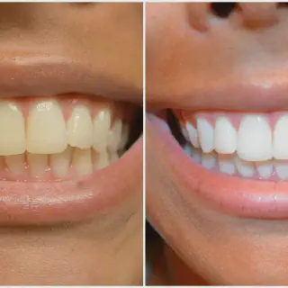 /img/25236-healthy-smile.webp
