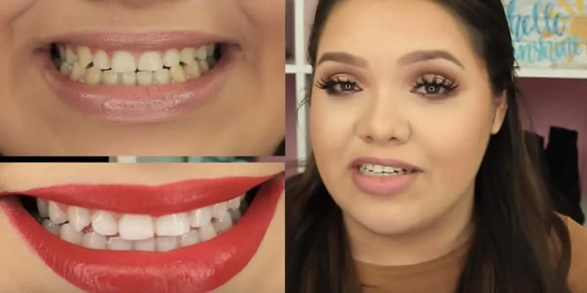 25237 teeth discoloration
