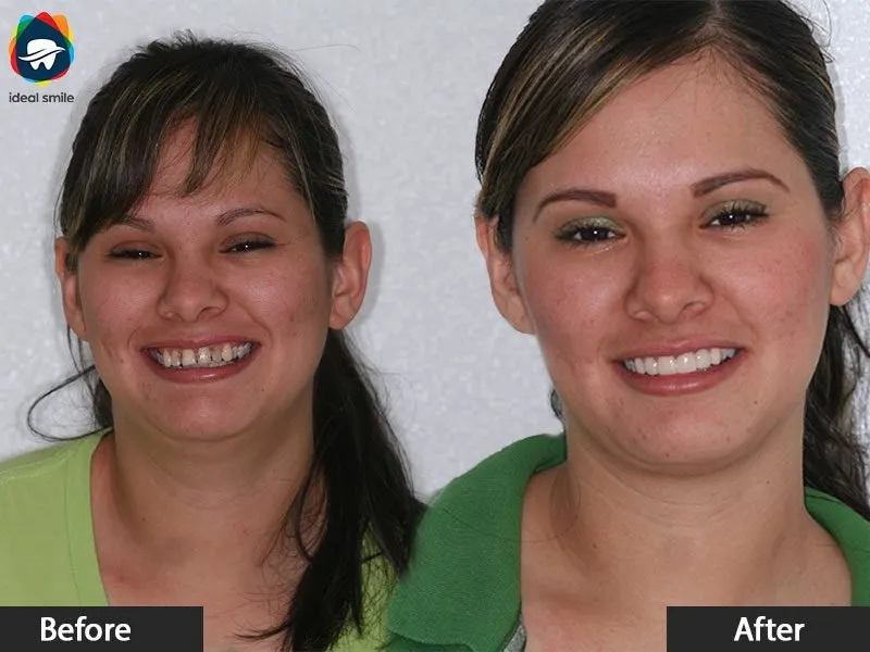 25240 in office teeth whitening lahore