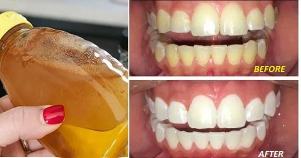 /img/25246-acv-teeth-whitening-7.webp
