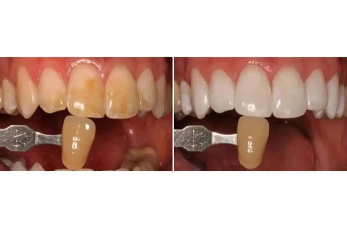 /img/25248-miami-teeth-whitening-groupon-8.webp