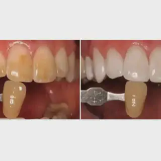 /img/25248-miami-teeth-whitening-groupon-8.webp