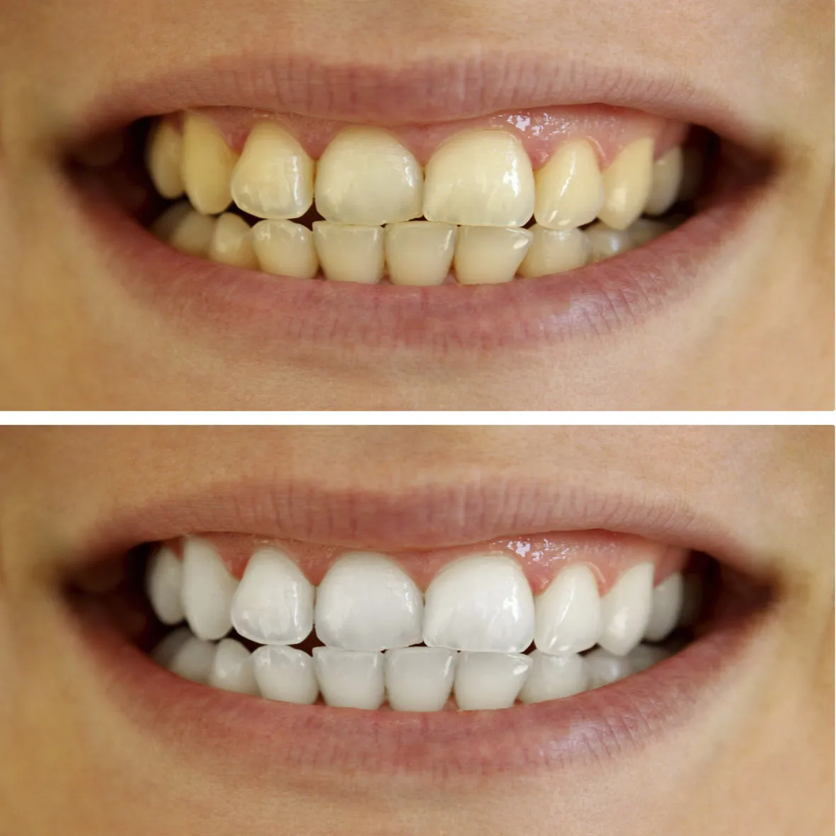 25255 baking soda teeth whitening