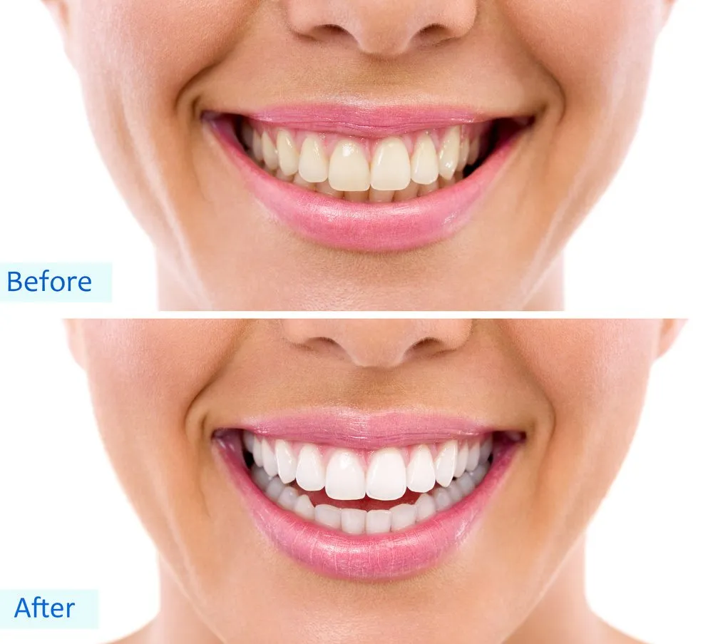 25257 in office teeth whitening