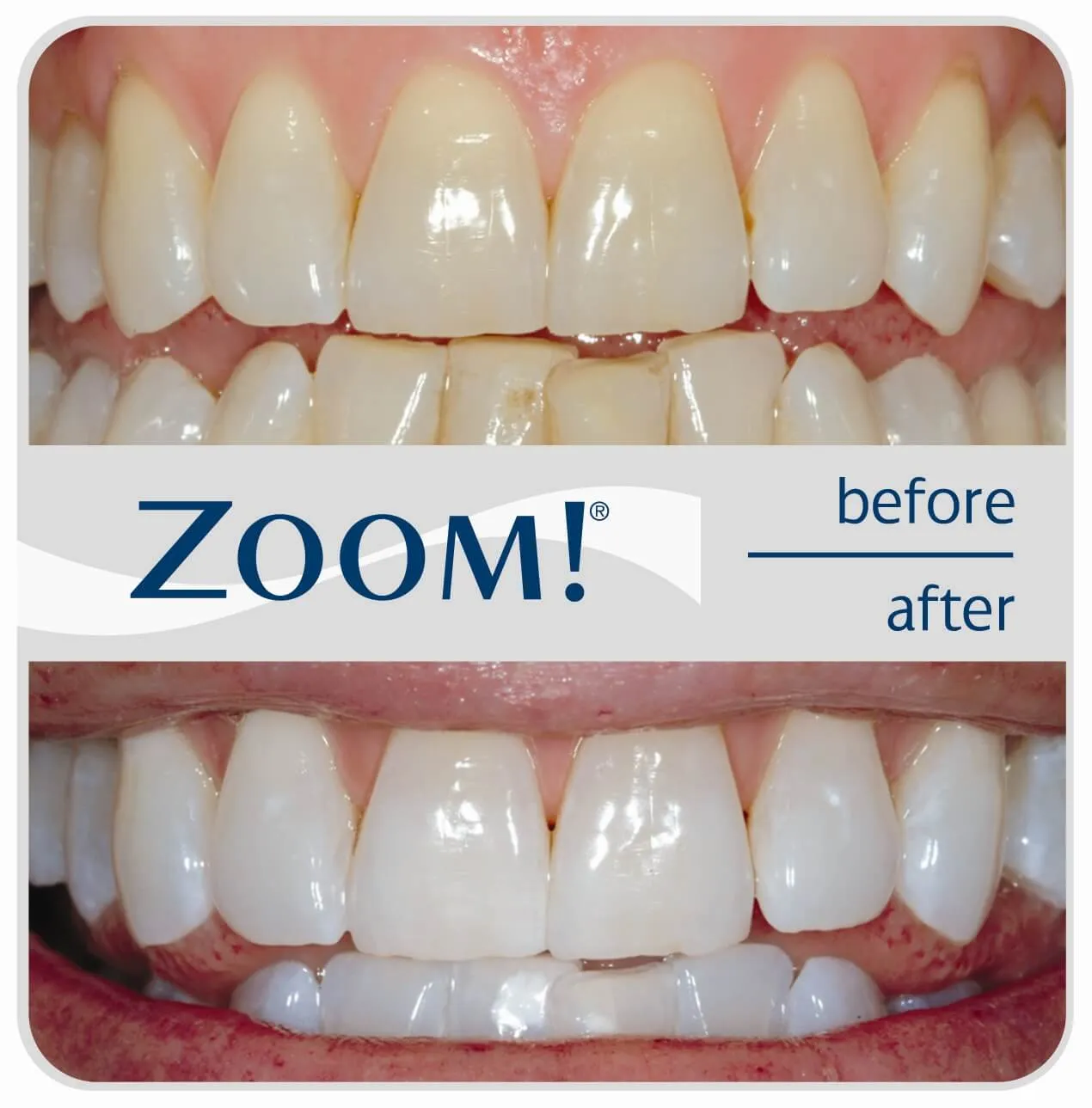 25257 teeth whitening options