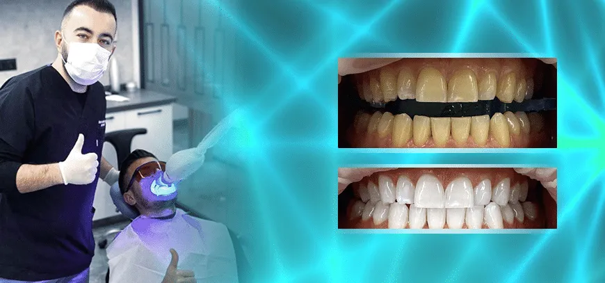 25260 over the counter whitening