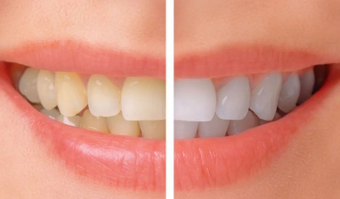 /img/25264-avoiding-staining-foods.webp