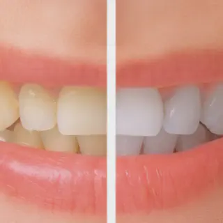 /img/25264-avoiding-staining-foods.webp