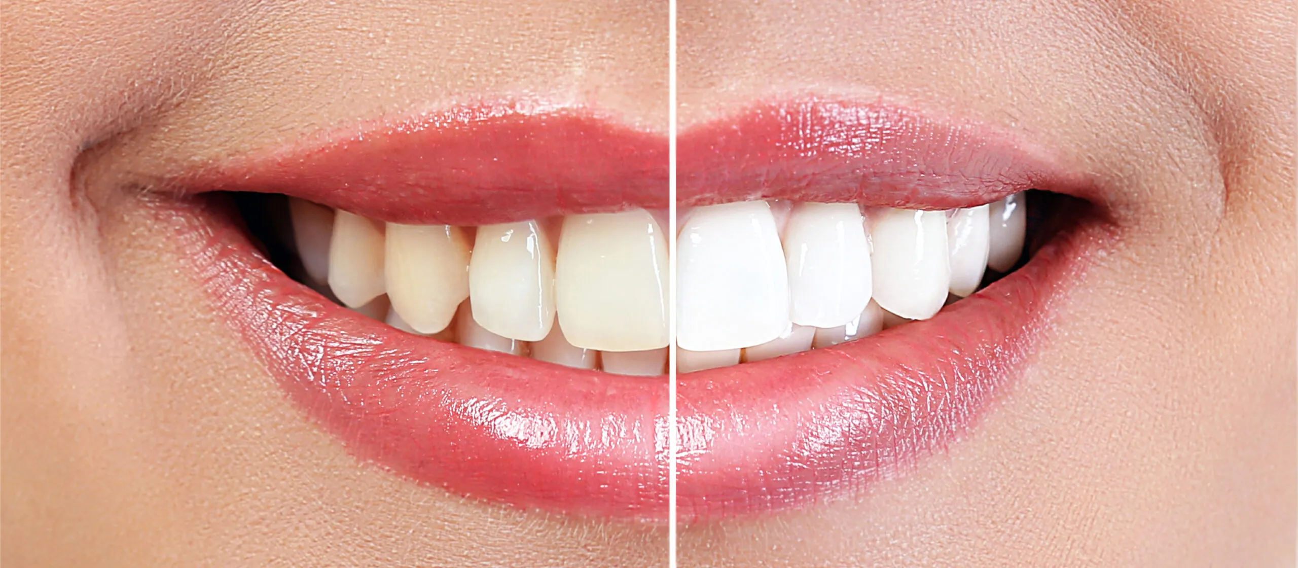 25264 consulting dentist teeth whitening