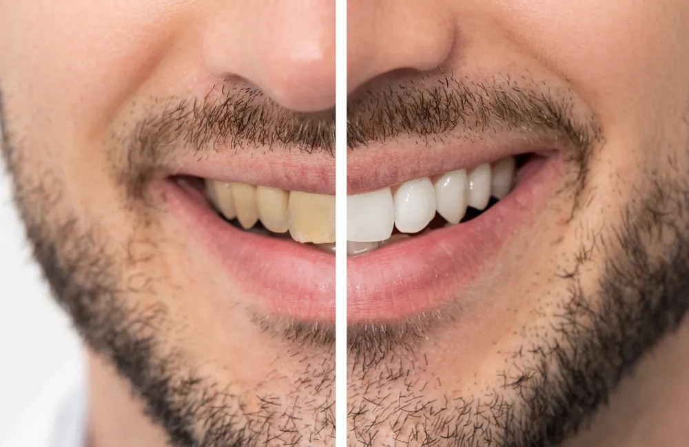25264 in office teeth whitening