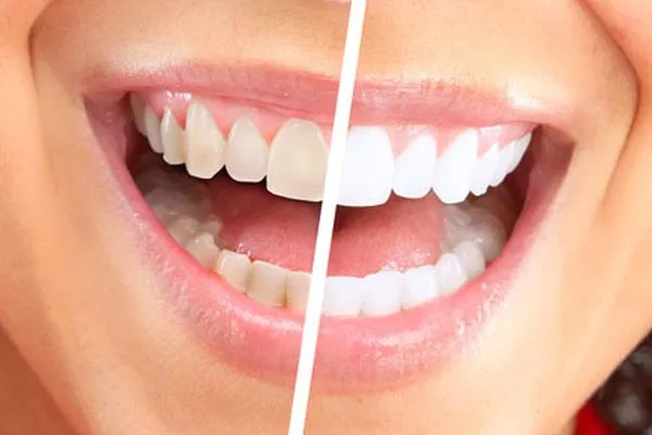 /img/25265-teeth-whitening-silver-spring-md-7.webp