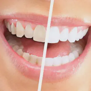 /img/25265-teeth-whitening-silver-spring-md-7.webp