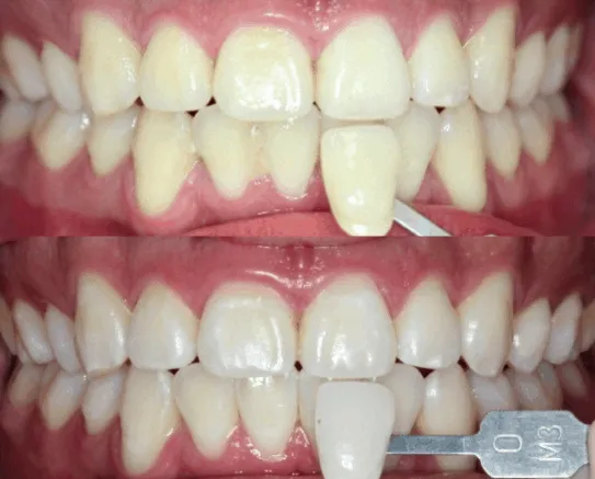 25273 teeth whitening longview tx image5