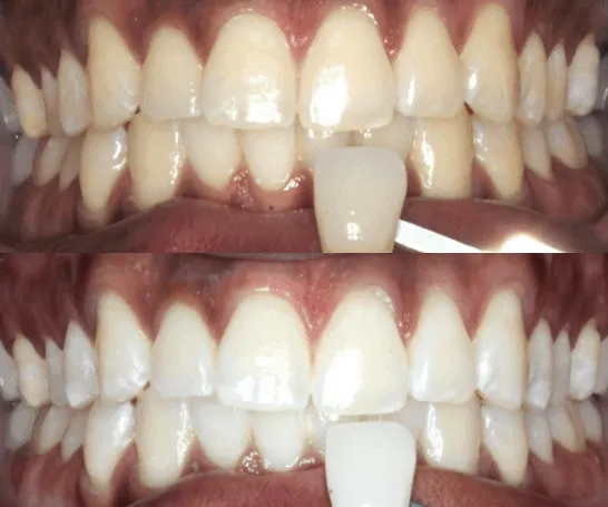 25273 teeth whitening longview tx image6