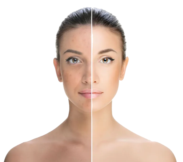 25278 acne scars treatment