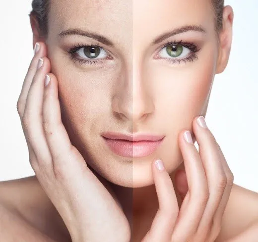 25278 face whitening remedy before after